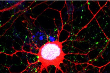 A glioblastoma cell  after the tumor came back (credit: Cancer Cell)