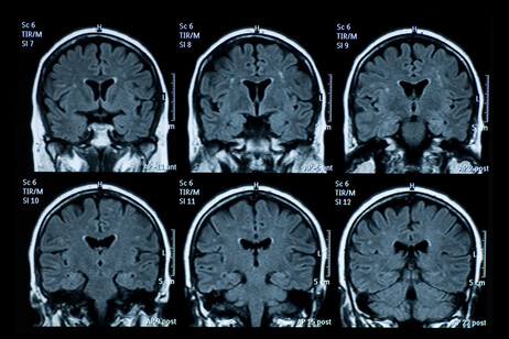 L'ipotesi di un virus per alcuni casi di Alzheimer