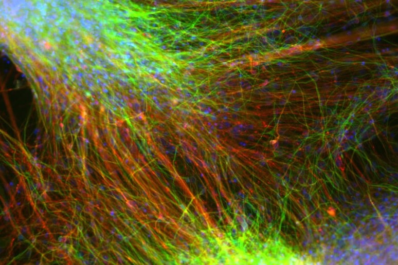 Neuroni differenziati a partire da cellule staminali embrionali impiantati in malati di Parkinson nella sperimentazione condotta in Europa (fonte: Malin Parmar Lab) - RIPRODUZIONE RISERVATA